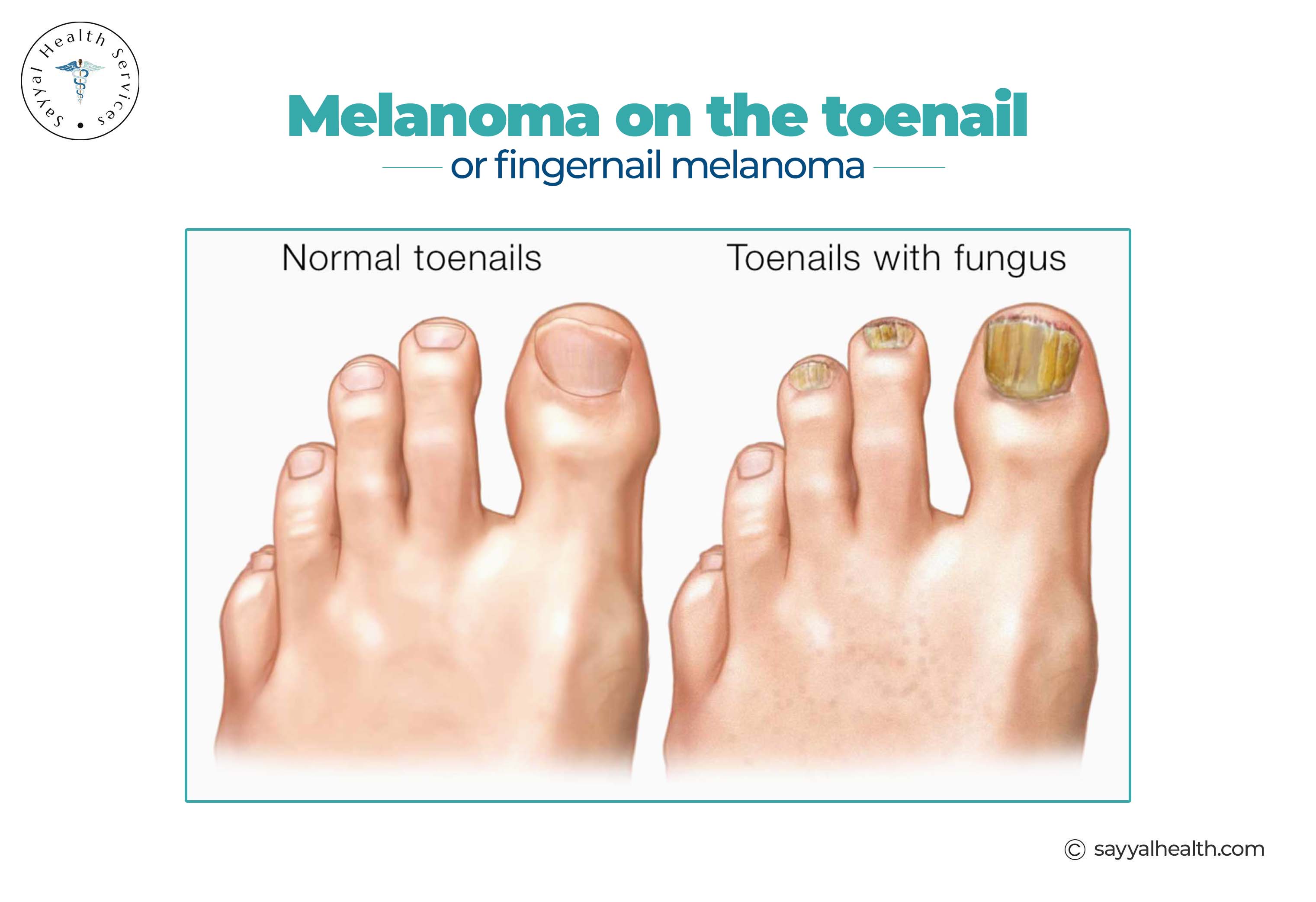 Comparison of normal toenails versus toenails with fungal infection and melanoma